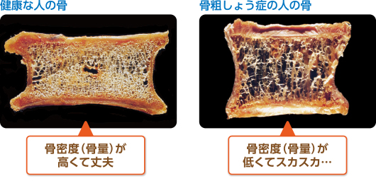 骨粗しょう症で、骨はどうなる?