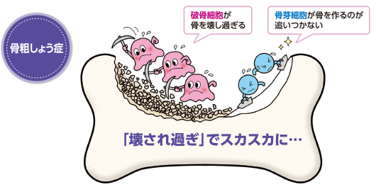 骨粗しょう症で骨が減るのはなぜ？