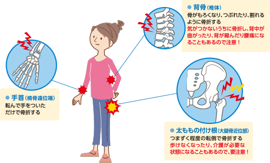 骨粗しょう症では、どこの骨が折れやすい？